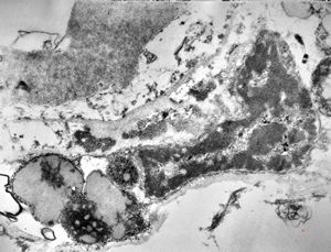 M,71y. | Alzheimer diseaseaccompanied with CADASIL